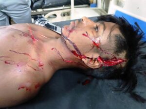 Singrauli News : बोलेरो वाहन के टक्कर से बाईक सवार दो बालक घायल
